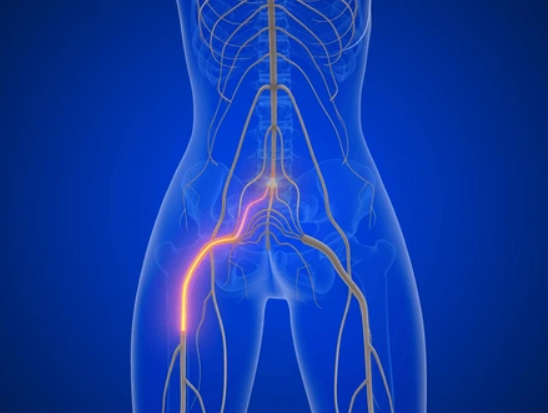 Sciatica